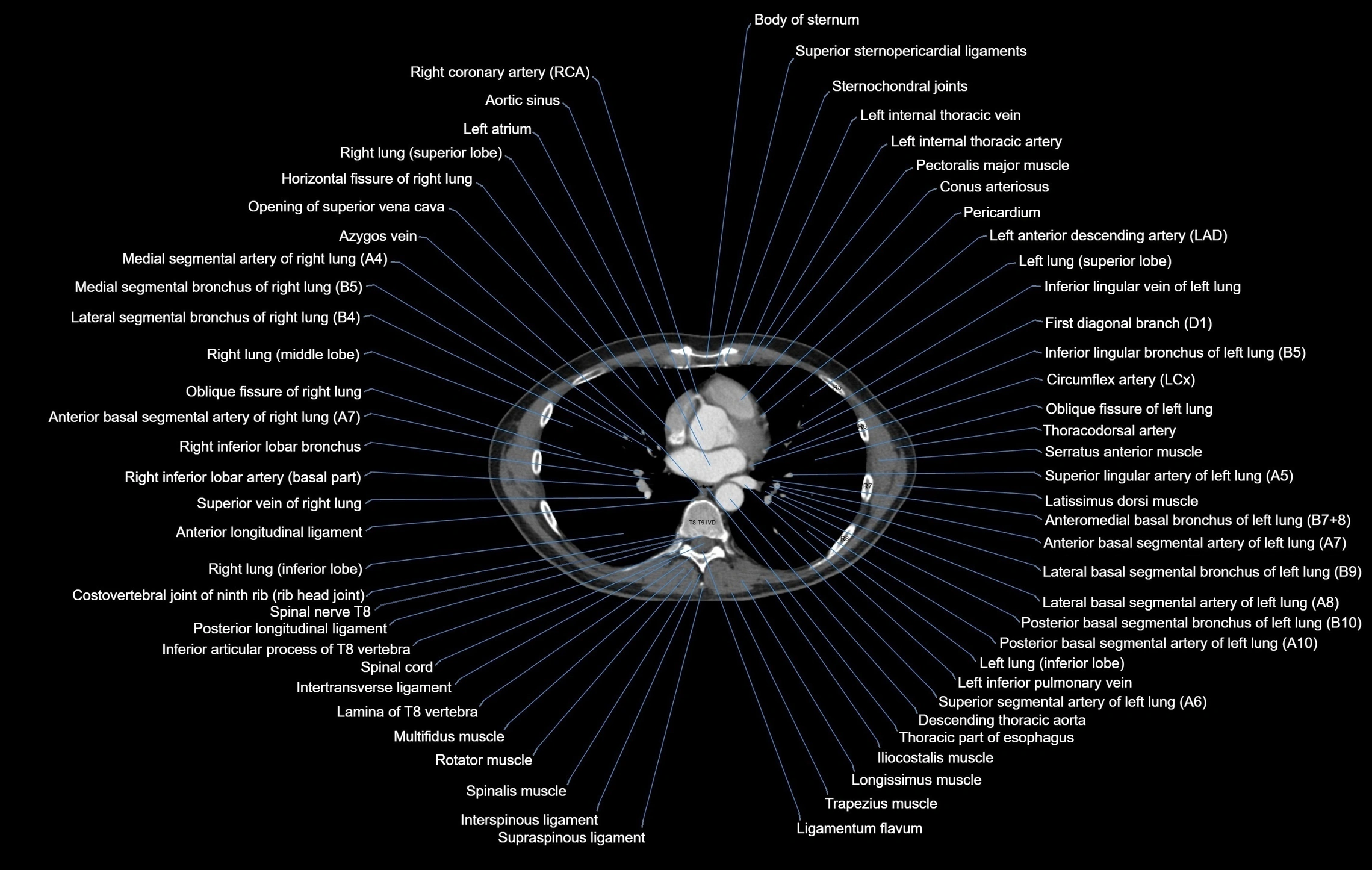 CT chest (thorax) soft tissue window labelled axial cross sectional anatomy radiology image-00070.webp